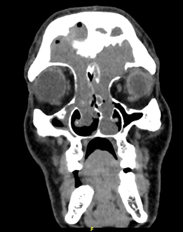 Coronal CT of paranasal sinuses.