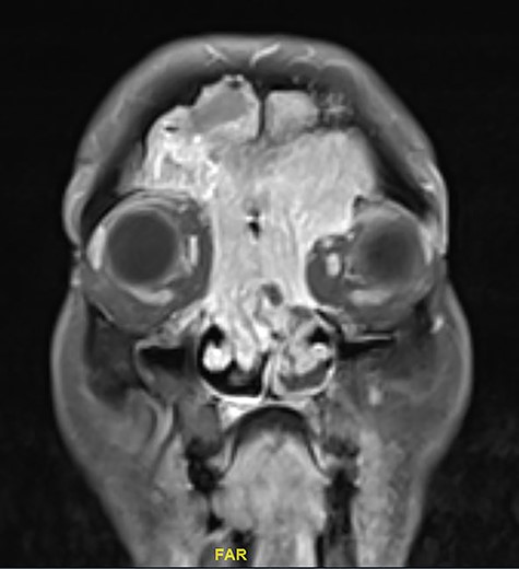 Coronal MRI of paranasal sinuses, T1-weighted image post contrast.