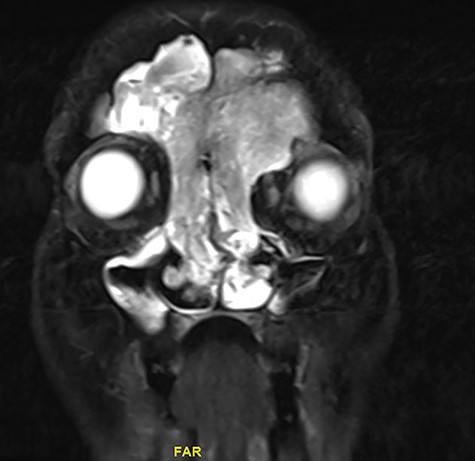 Coronal MRI of paranasal sinuses, T2-weighted image.