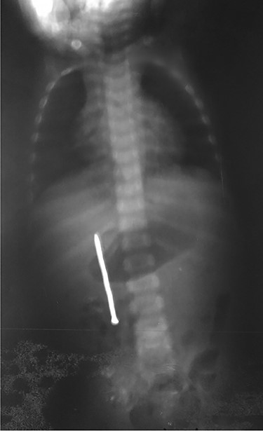 Ingested nail seen on the first plain abdominal radiography.