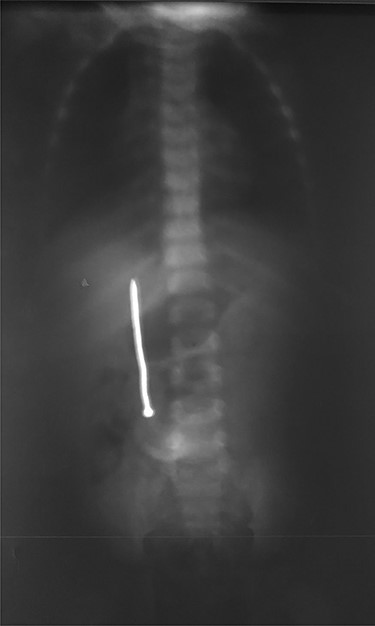 Ingested nail seen on the second plain abdominal radiography.