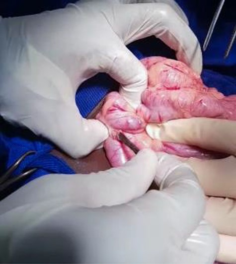 Nail extracted through minim colic incision.