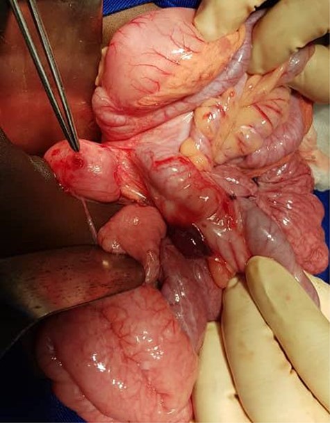 Duodenum anterior wall perforation.