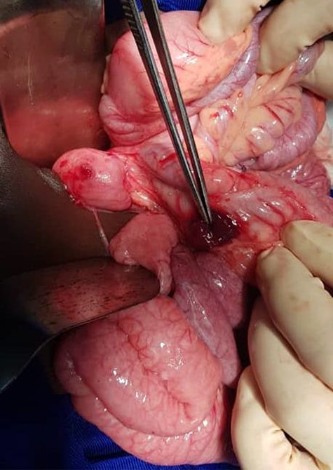 Ascending colon posterior wall perforation.