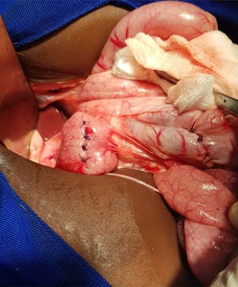 Perforations repairs.