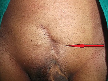 Abdominal scar due to previous surgery in supine position.