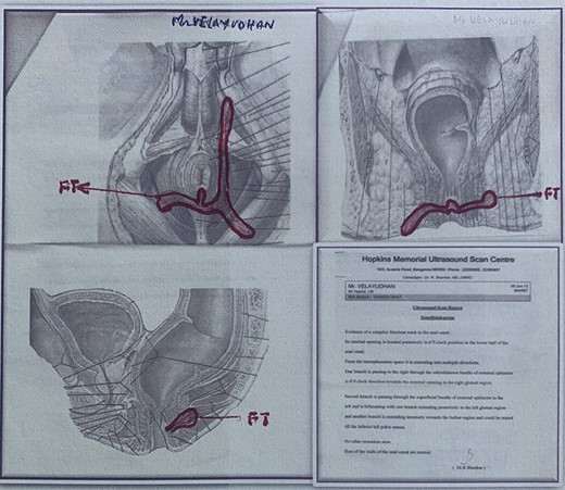 Transrectal scan before Ksharasutra treatment.