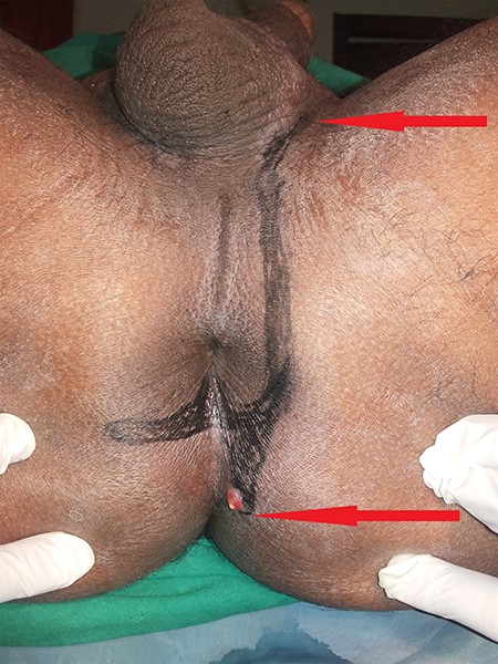 Marking of course of fistula on perianus region of patient in lithotomic position.