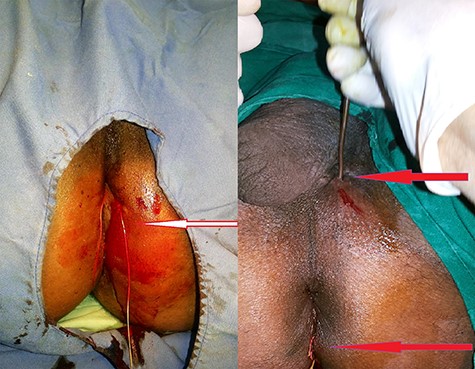 Seton placed to 5' o clock to internal opening and 5' o clock to 11' o clock (base of the scrotum).