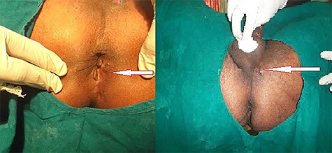 In lithotomic position healed sinus at base of scrotum and ischiorectal fossa.