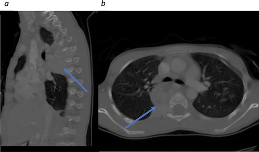Initial CT scans. (a) Sagittal view, tumor noted in the mediastinal area between T4–T7. (b) Axial view showing tumor causing no narrowing of the spinal canal.