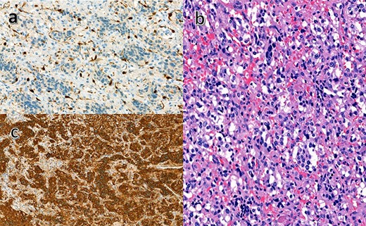 Histopathology of the excised specimen. (a) The sustentacular cells of the spinal metastases of pheochromocytoma showing characteristic staining of S100. (b) Nests of tumor cells showing significant nuclear pleomorphism with prominent nucleoli (hematoxylin and eosin). (c) Positive chromaffin cells. Chromogranin A is noted in the secretory granules (chromogranin A immunostaining).