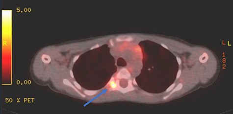 PET scan showing area of focal enhancement at the level of the tumor.