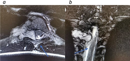 Redemonstrations of tumor post VATS. (a) Axial view tumor noted with arrow causing significant narrowing of the canal. (b) Coronal view of thoracic spine showing involvement of the spinal canal.