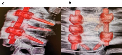 CT images 6 months post tumor removal and instrumentation. (a) Sagittal view and (b) coronal view.