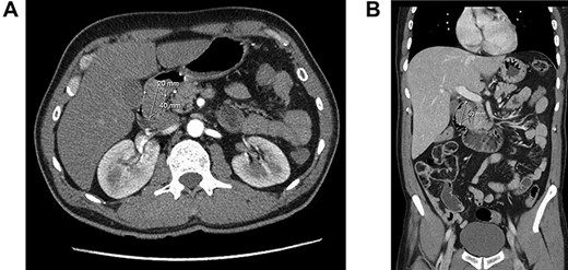 Computed tomography of duodenal Brunner’s gland hamartoma. (a) Axial plane. (b) Coronal plane.