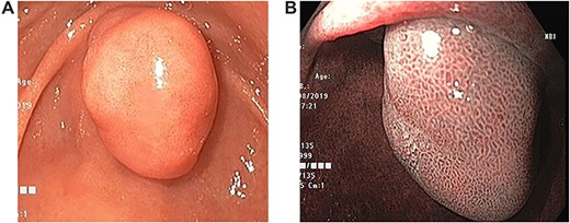 Endoscopic images. (a) Large duodenal submucosal lesion protruding through the pylorus to gastric antrum. (b) Narrow Band Imaging with normal tubulovillous mucosal patterns with regular vessels.