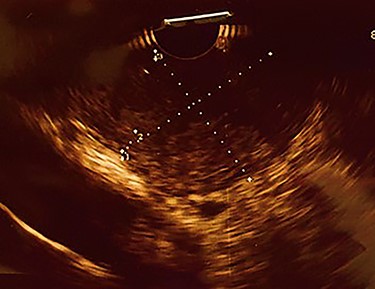 Endoscopic ultrasound, showing heterogeneous hypoechoic subepithelial lesion.