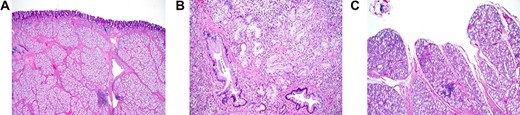 Histopathology of Brunner’s gland hamartoma. (a) The submucosal lesion consisted of lobules of proliferating bland Brunner’s glands, separated by fibromuscular septa; scattered lymphoid follicles were evident (Hematoxylin and Eosin × 100). (b) Irregularly-shaped ductal structures were present, mainly at the deep aspect of the lesion (Hematoxylin and Eosin × 400). (c) Focal papillary architecture was evident on the surface of the lesion (hematoxylin and eosin × 200).