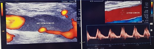 Preoperative DUS study.