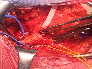 Patching of the CFA.