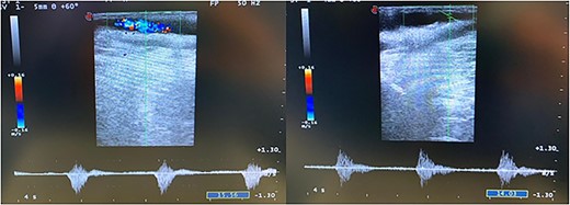 Intraoperative completion DUS following patch angioplasty.