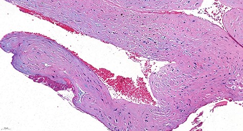 Histologically, the wall of the cyst consisted of paucicellular connective fibrous tissue. No epithelial lining was evident (H&E stain, ×20).