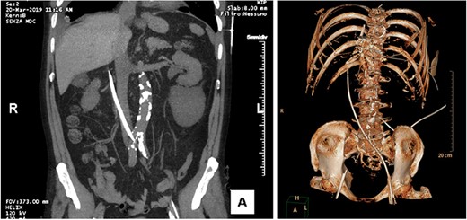 CT performed in urgency after catheter introduction shows the probe at the right side of the L2–L3 vertebral bodies, with the tip lying next to the portal vein.