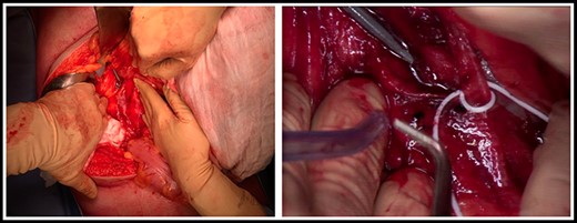 Intraoperative pictures showing the distal part of the probe outside the IVC.