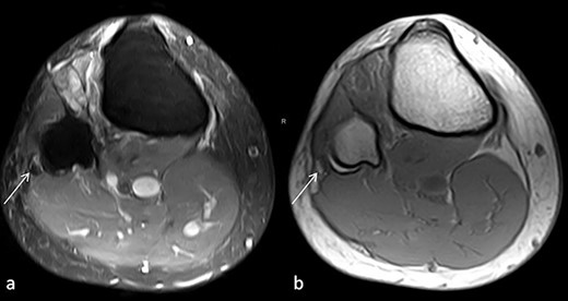 (a) Proton density, fat-saturated-weighted (PD FAT SAT) axial image: the arrow marks the swollen, hypointense peroneal nerve at the level of fibular head. (b) T1-weighted axial image: the arrow tags a hyperintense lesion in position of the peroneal nerve that may correspond to the intraneural haemorrhage.