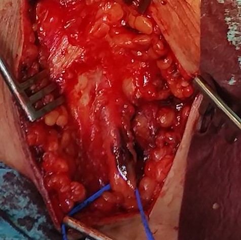 Intraoperative photograph of the common peroneal nerve showing the hematoma (black discoloration).