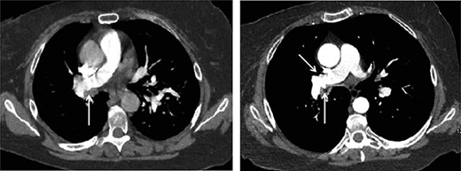 (1a) Axial CT chest slice shows small irregularity of right pulmonary artery wall (white arrow) with clot-filled bronchus. (1b) Axial CT chest slice shows increased irregularity of right pulmonary artery wall (white arrow) with open lumen bronchus. Possible opposite side pulmonary artery wall irregularity (yellow arrow).