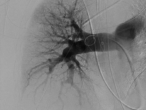 Pulmonary arteriogram with no visualization of right pulmonary artery wall irregularity.