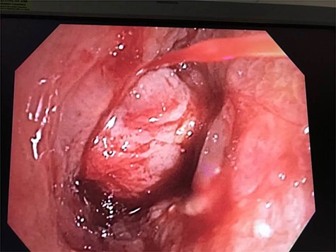 Bronchoscopic view of distal bronchus intermedius with surrounding inflammation and structure deceptive for endobronchial mass.