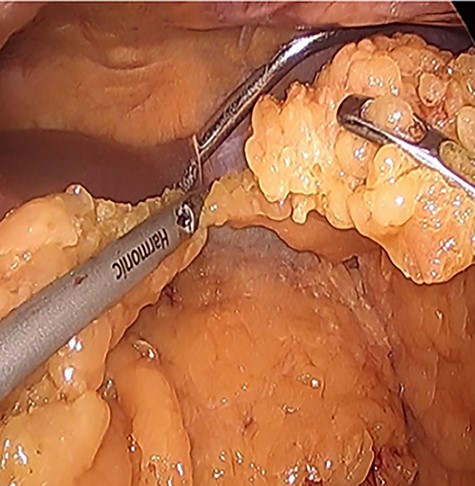 Omental division for preparation of antecolic gastrojejunostomy during index laparoscopic RYGB.