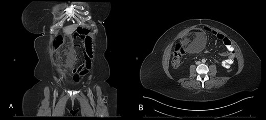 A and B: Abdominal and pelvic CT scan obtained at POD # 21 readmission for abdominal pain showing a 17.7-cm mixed attenuating lesion extending anterior to the transverse colon into the upper-pelvis-associated stranding and fluid level suggestive of omental infarction and liquefied necrosis.
