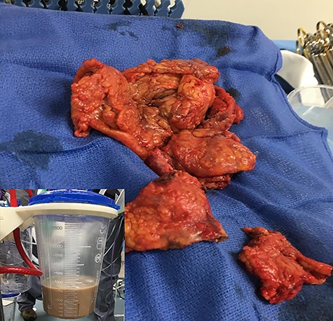 Resected infarcted omentum with central necrotic cavity and liquefied fat and purulent fluid.
