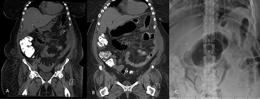 A: Abdominal and pelvic CT scan obtained at POD # 29. From index RYGB and POD # 8 from excision of infarcted omentum showing loculated perisplenic, pelvic and perihepatic fluid collections. B and C: Abdominal and pelvic CT scan obtained at POD # 20 from take back and plain X-ray showing gaseous distention of the excluded stomach and duodenum, confirming a small bowel obstruction of the biliopancreatic limb.