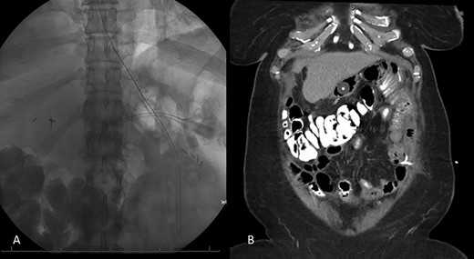 Resolution of small bowel obstruction. A: Plain X-ray at POD # 25 from take back showing endoscopically placed nasogastric tube placement near JJ anastomosis B: Abdominal and pelvic CT scan showing percutaneous gastrostomy tube within the excluded stomach and pigtail catheter in the left hemiabdomen.