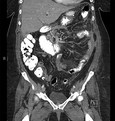 Follow-up abdominal and pelvic CT scan at POD # 35 with interval resolution of intra-abdominal abscess and small bowel obstruction.