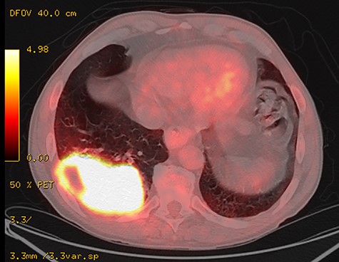Positron emission tomography–CT scan of the primary tumour originating in the right inferior lobe and invading the adjacent thoracic wall.