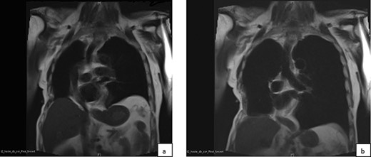 In dynamic magnetic resonance imaging examination of the thorax in coronary view in end-expiration (a) and end-inspiration (b) a paradox movement of the reconstructed area of the chest wall is observed.