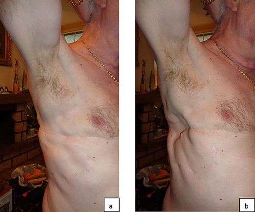 The result 3 years after surgery in expiration (a) and deep inspiration (b) demonstrates a paradox movement locally.