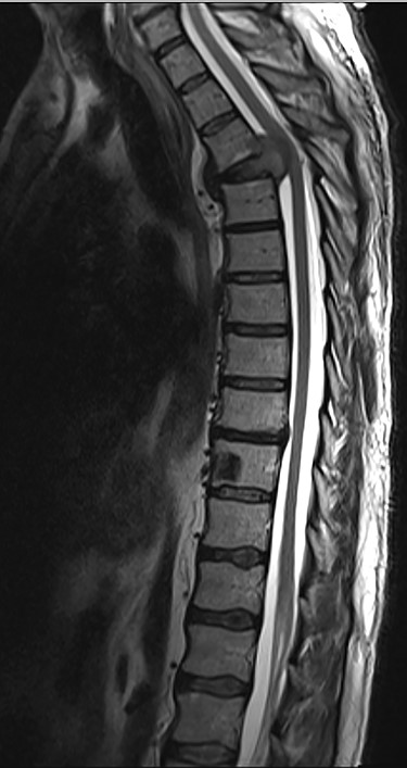 Sagittal T2-weighted magnetic resonance image (T2W MRI) with T4 metastatic epidural spinal cord compression (MESCC) and a synchronous T10 lytic lesion.