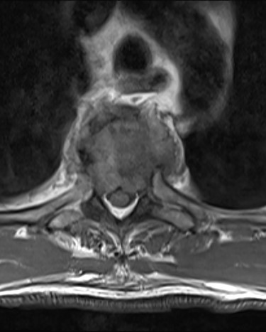 Axial T2W MRI of the T4 MESCC.