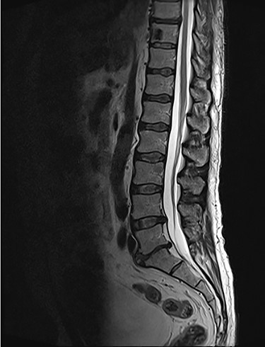 Sagottal T2W MRI showing synchronous lytic lesions in T10 & L3 vertebral bodies.