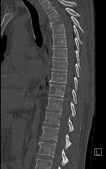 Sagittal computed tomography (CT) scan demonstrated multiple lytic lesions and pathological fracture of the T4 vertebra with almost complete collapse along with kyphotic deformity.