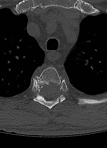 Axial CT showing both destroyed T4 pedicles.