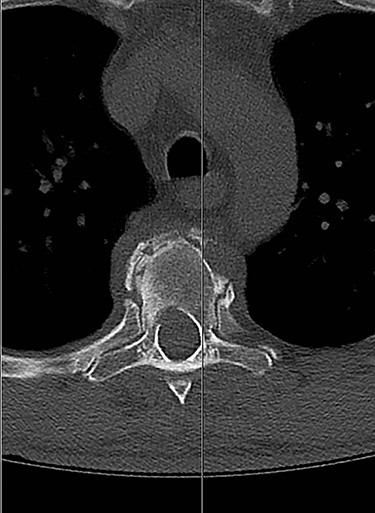 Minimally displaced fractures of both T5 pedicles.