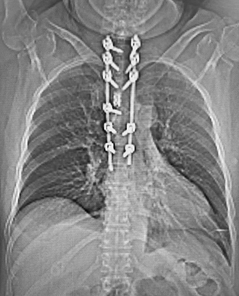 Post-operative CT with reconstructed anteroposterior view of the T1–T7 pedicle screw fixation and expandable titanium cage in situ.
